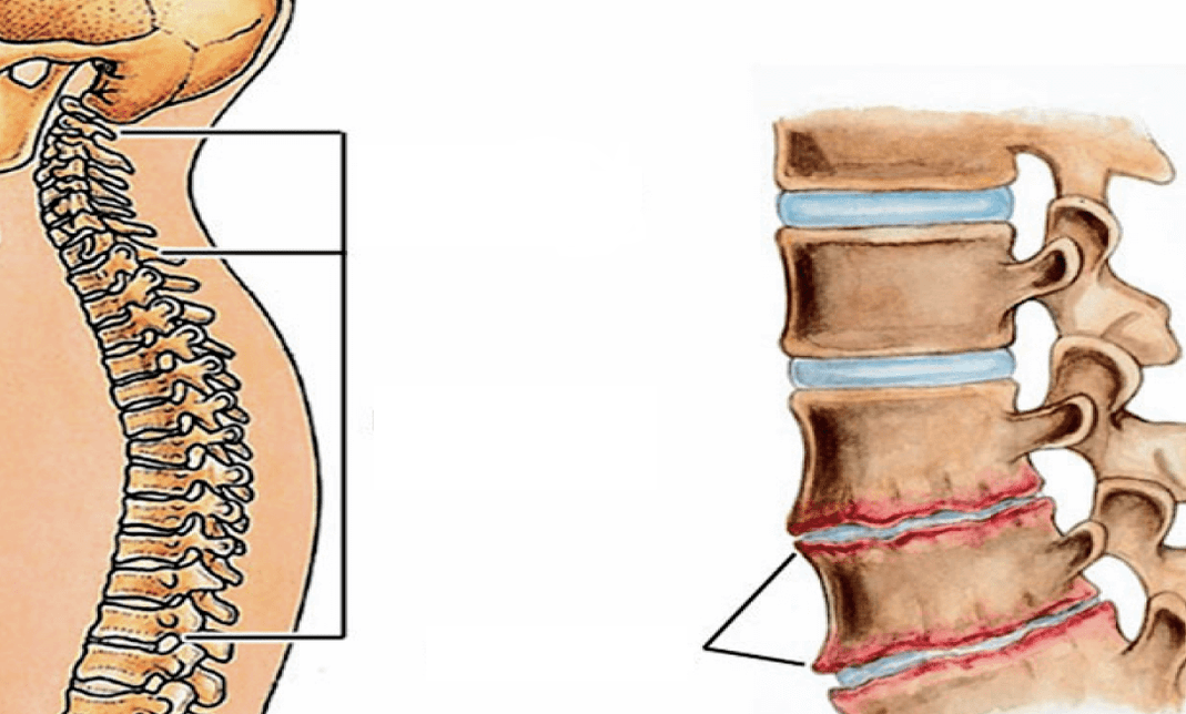 Bizkarrezurraren osteochondrosak zer itxura du