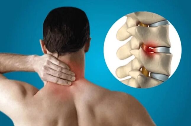 Bizkarrezurraren osteokondrosia
