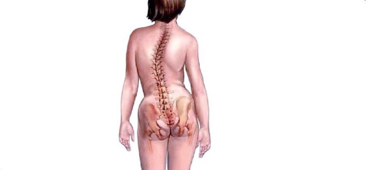 Osteokondrosia